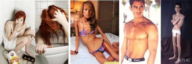 bulimia-anorexia